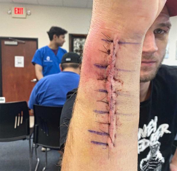 Дэн Хукер показал сломанную в бою руку после операции